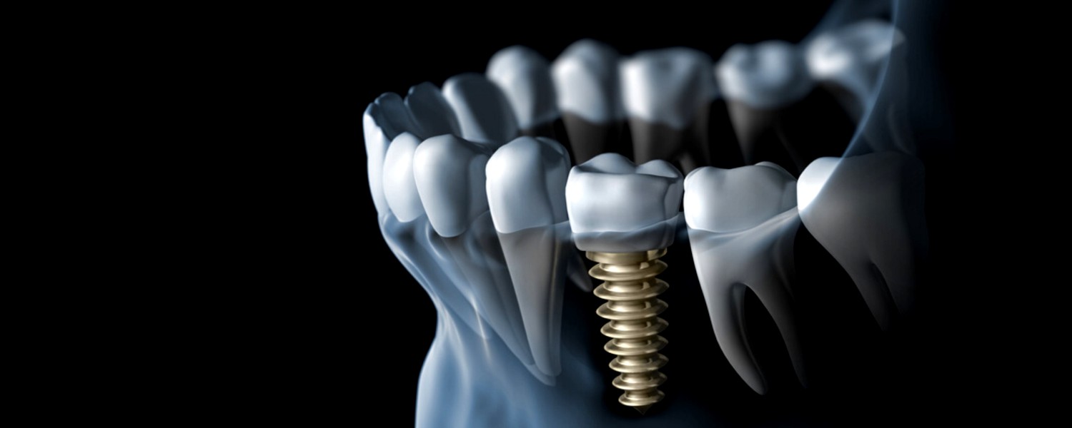 Implantes Dentales <span>Instalación y Rehabilitación</span>