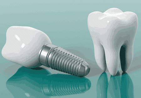 Que es un implante dental