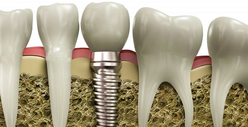 Densidad Osea en Implantes dentales