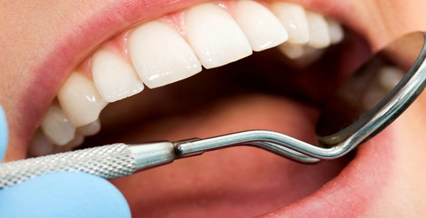 Mantención Implantes Dentales