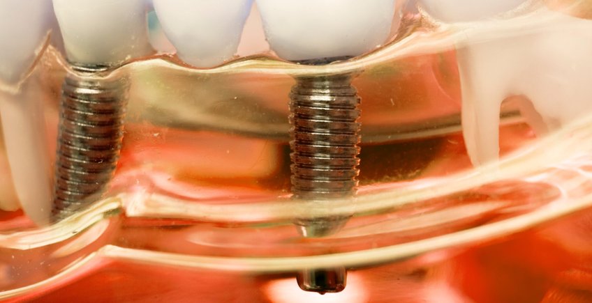 Cuidando cada detalle de la preparacion del implante dental