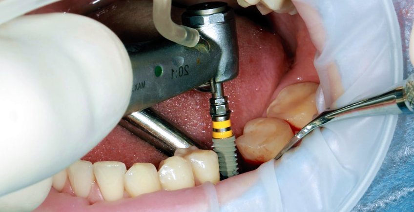Procedimiento Implante Dental
