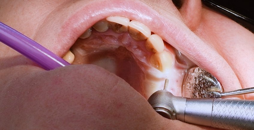Proceso de Reemplazo de Implantes Dentales