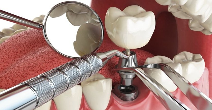 Reemplazo de  Implantes dentales