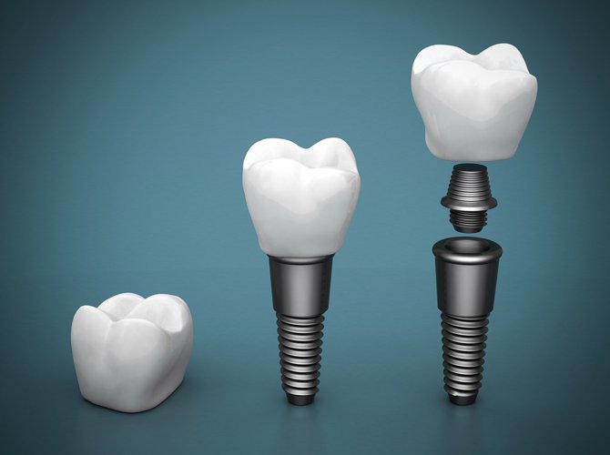 Puede caerse un implante dental