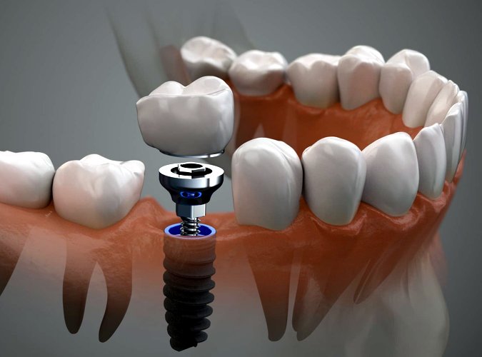 Tiempos de Recuperación en los Implantes Dentales