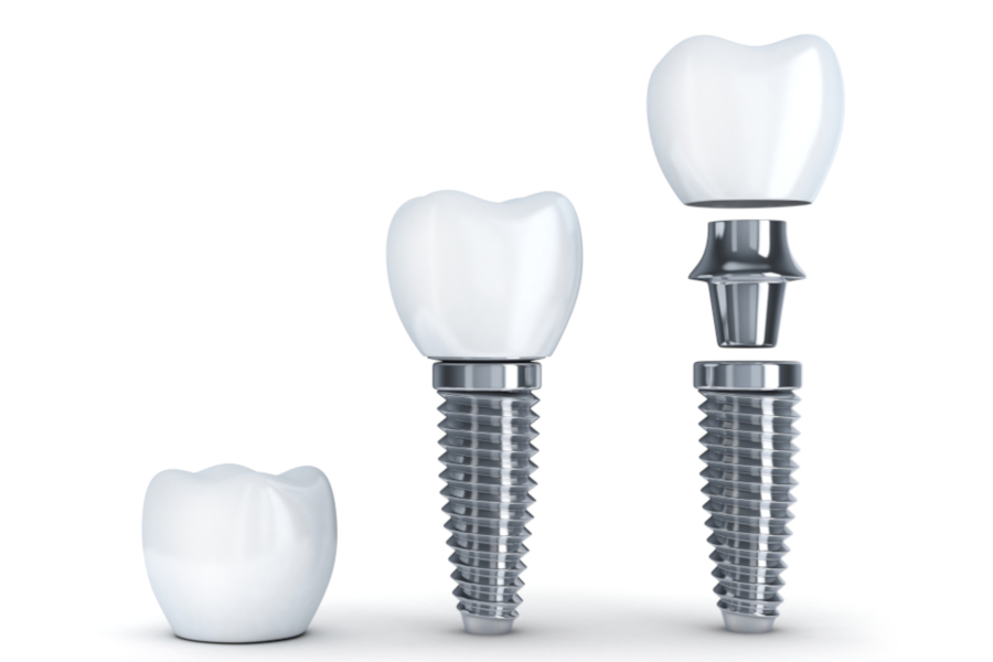 Implantes Dentales en Concepción, Bíobio